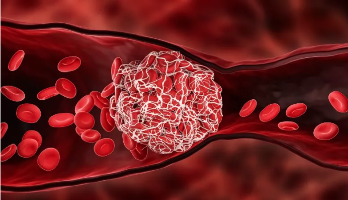 Blood clots: invisible and dangerous to health and life. How to ...